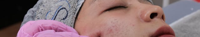 The Radiofrequency Microneedling Procedure