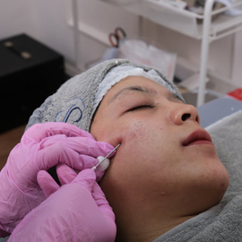 The Radiofrequency Microneedling Procedure